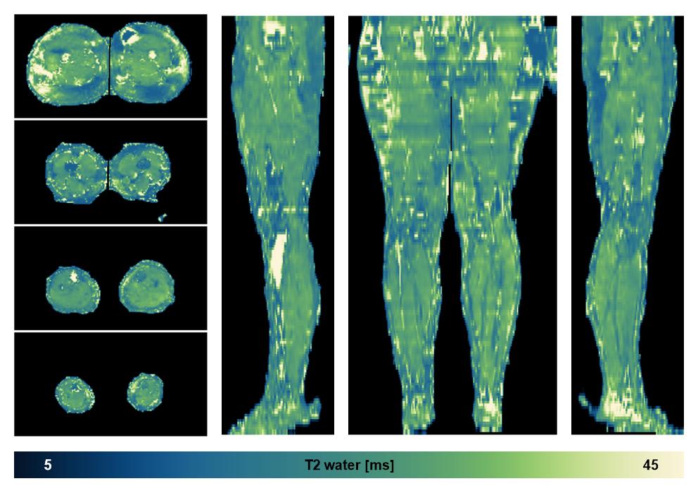 The water only T2 relaxation time of the lower extremity obtained from multi echo spin echo t2 mapping with EPG based reconstruction.